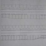 trace holter ecg